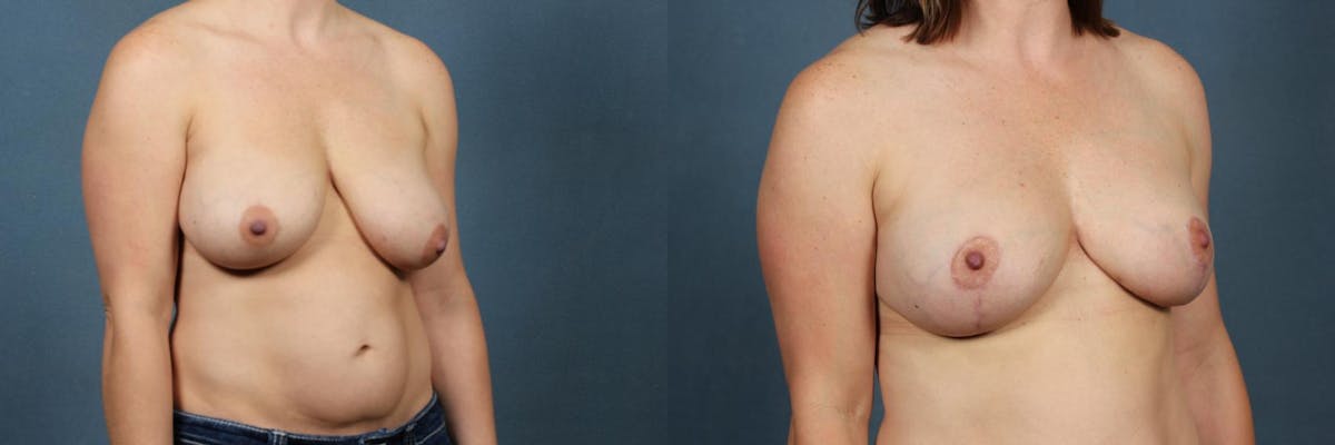 Lift Before & After Gallery - Patient 292116 - Image 2