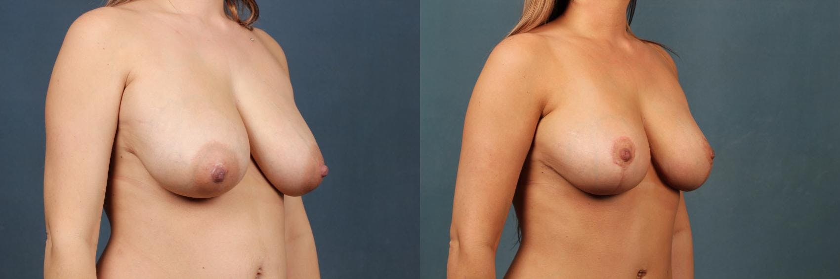 Lift Before & After Gallery - Patient 150207 - Image 2