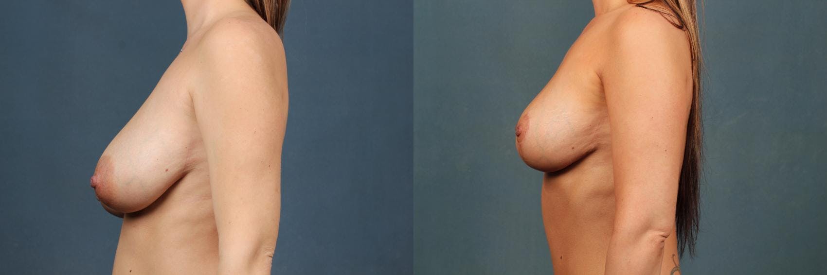 Lift Before & After Gallery - Patient 150207 - Image 3