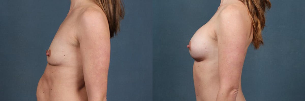 Enlargement - Silicone Before & After Gallery - Patient 653100 - Image 3