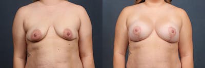 Lift Before & After Gallery - Patient 186244 - Image 1
