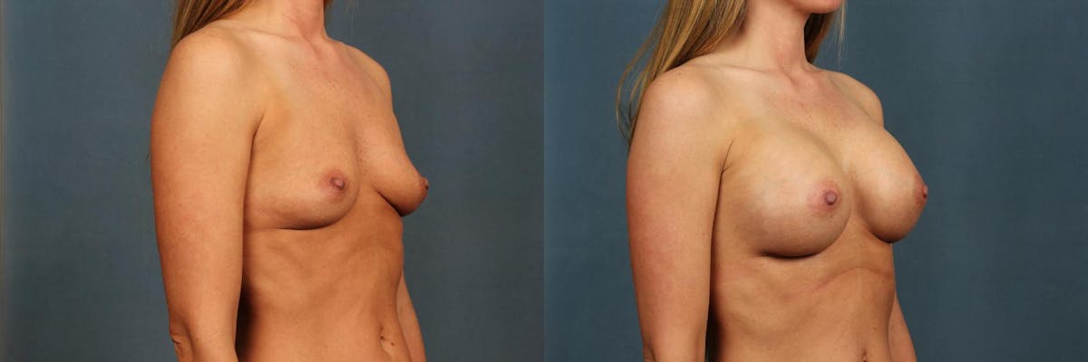 Enlargement - Silicone Before & After Gallery - Patient 243424 - Image 2