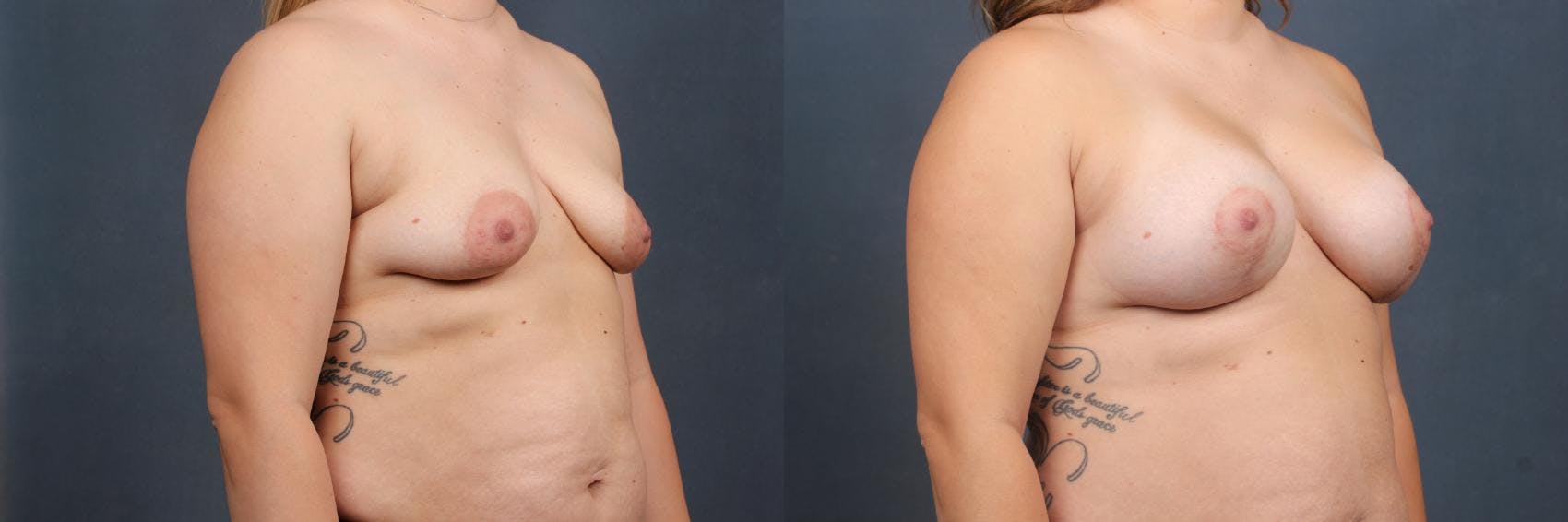 Lift Before & After Gallery - Patient 186244 - Image 2