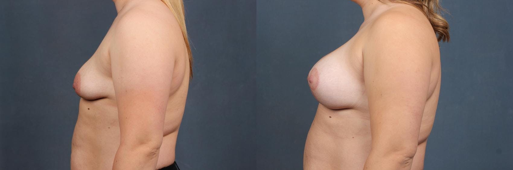 Lift Before & After Gallery - Patient 186244 - Image 3