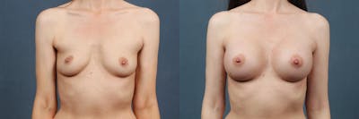 Enlargement - Silicone Before & After Gallery - Patient 137605 - Image 1