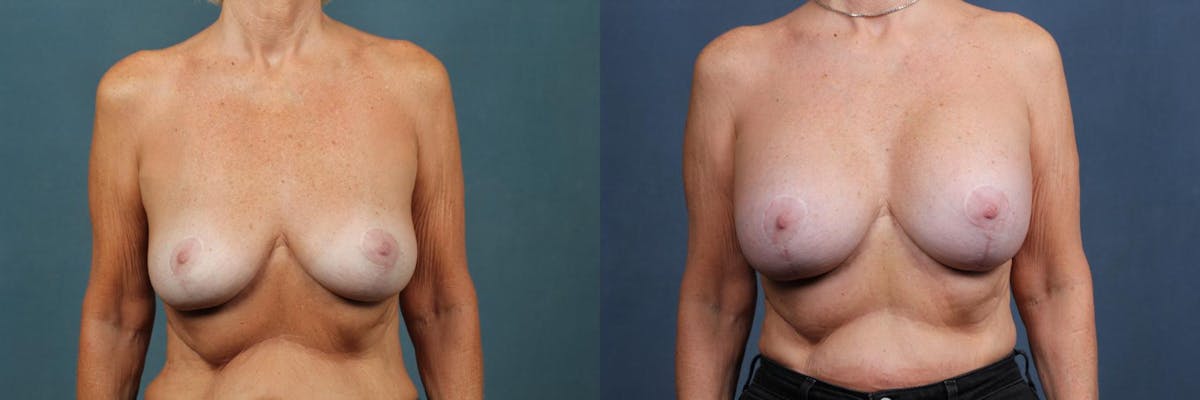 Lift Before & After Gallery - Patient 417661 - Image 1