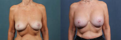 Lift Before & After Gallery - Patient 417661 - Image 1