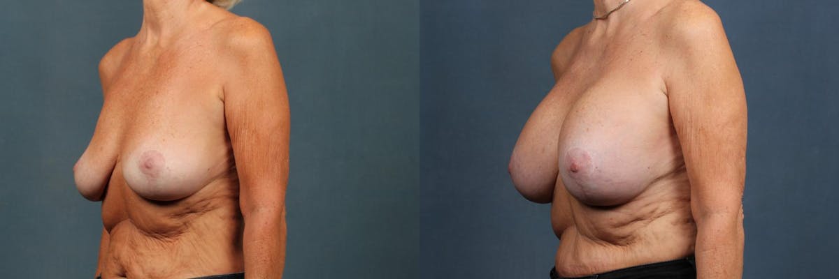Lift Before & After Gallery - Patient 417661 - Image 2