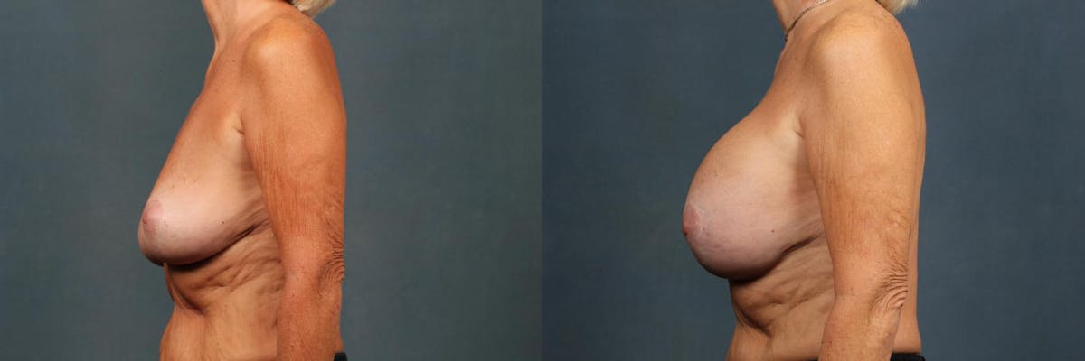 Lift Before & After Gallery - Patient 417661 - Image 3