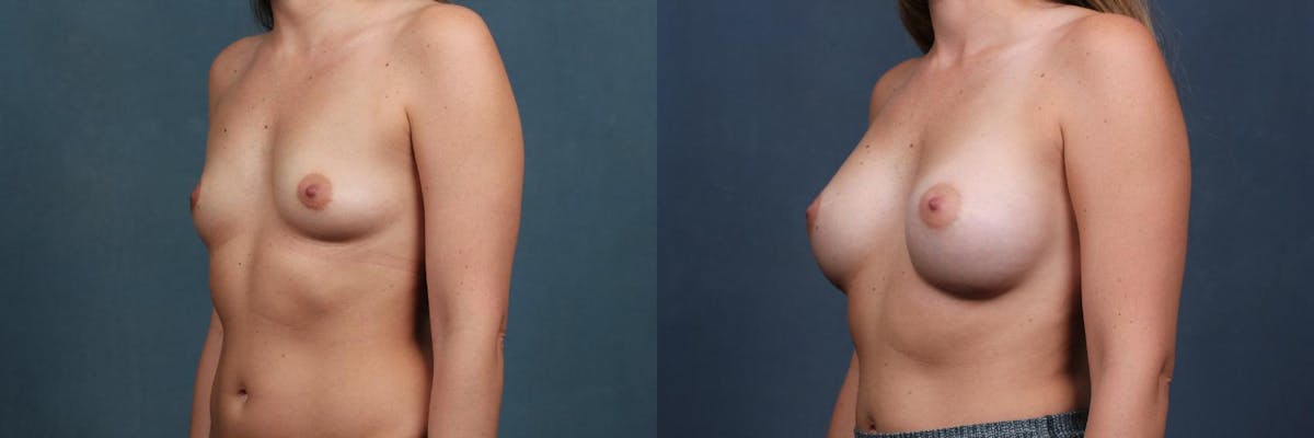 Enlargement - Silicone Before & After Gallery - Patient 238076 - Image 2