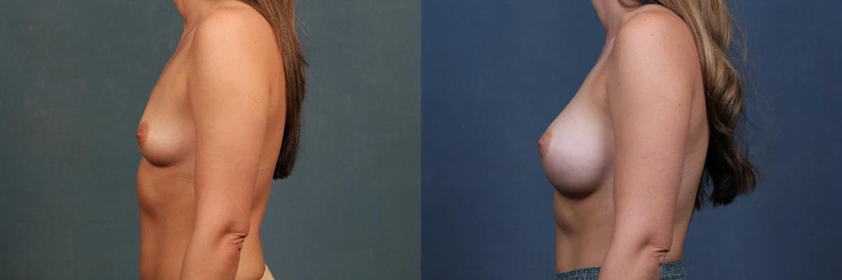 Enlargement - Silicone Before & After Gallery - Patient 238076 - Image 3
