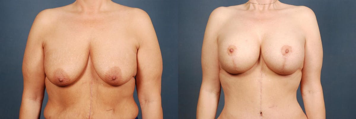 Lift Before & After Gallery - Patient 254094 - Image 1