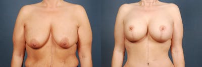 Lift Before & After Gallery - Patient 254094 - Image 1