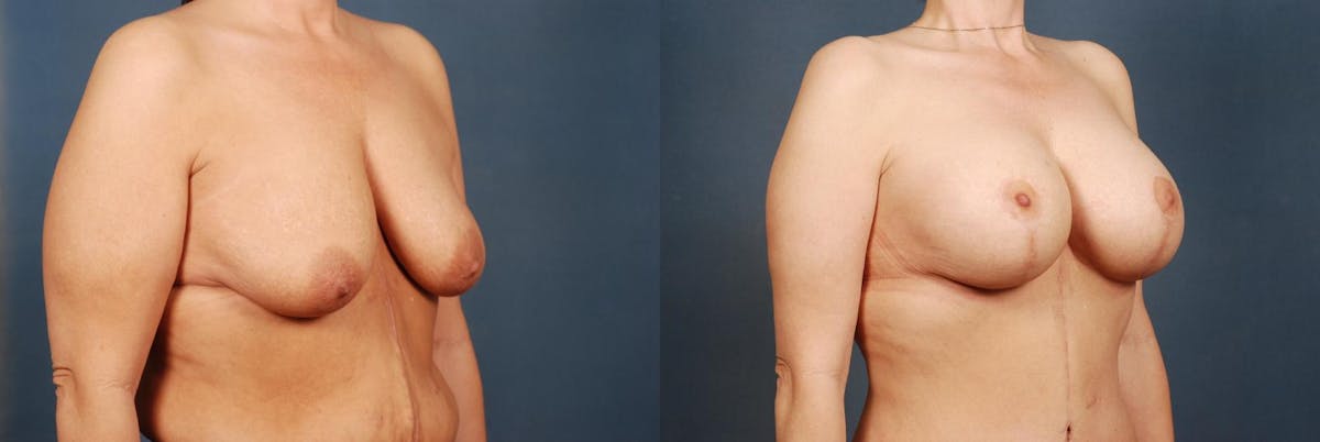 Lift Before & After Gallery - Patient 254094 - Image 2