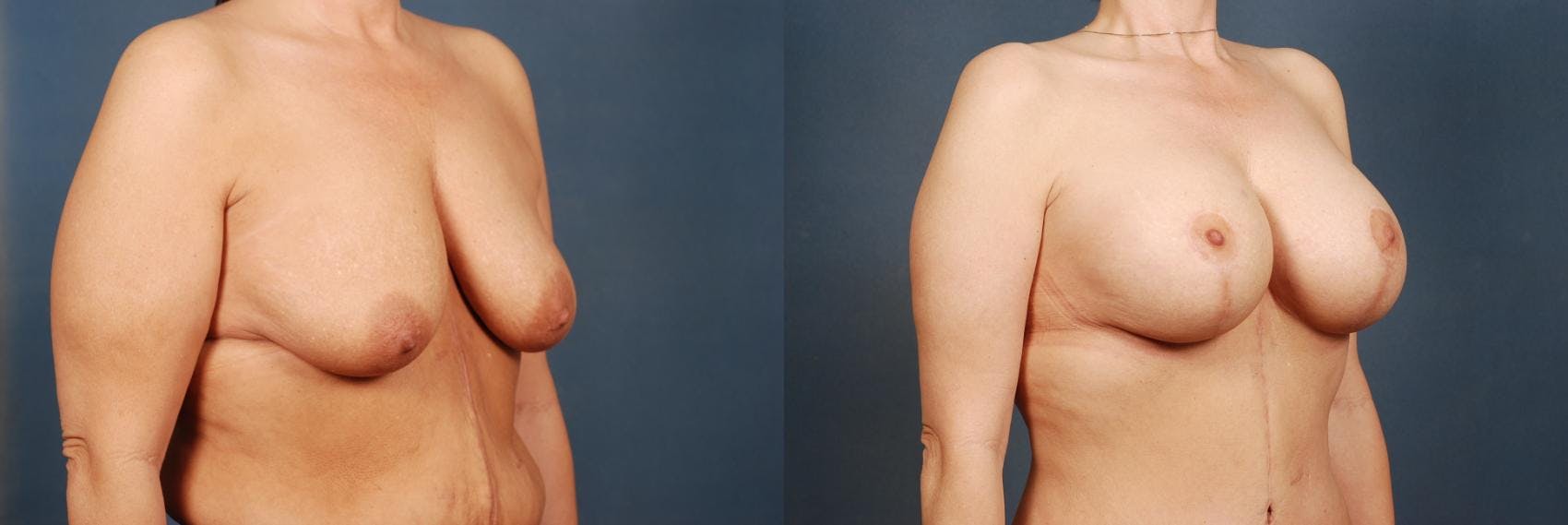 Lift Before & After Gallery - Patient 254094 - Image 2