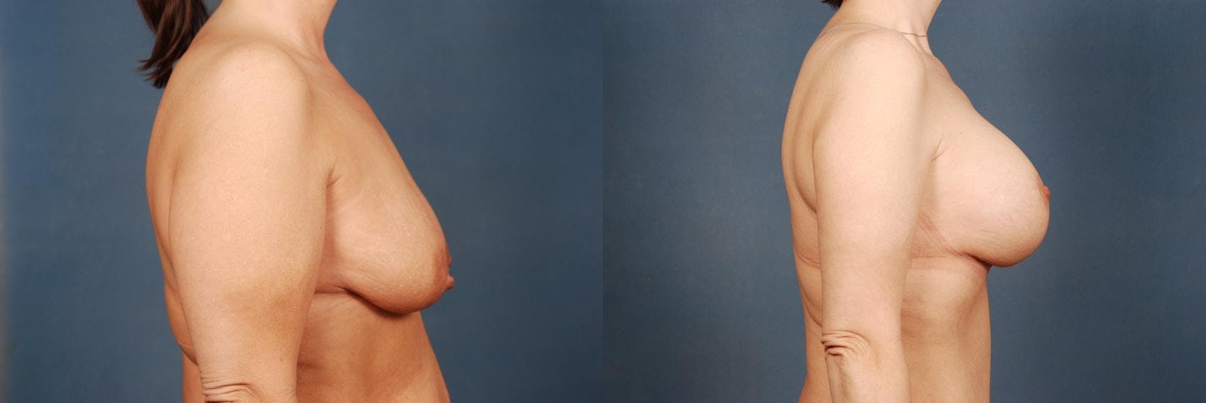 Lift Before & After Gallery - Patient 254094 - Image 3