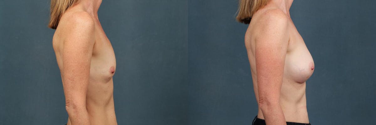 Enlargement - Silicone Before & After Gallery - Patient 155487 - Image 3