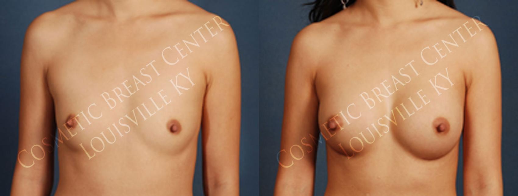 silicone breast augmentation results
