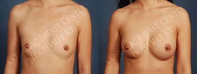 Enlargement - Silicone Before & After Gallery - Patient 255213 - Image 1