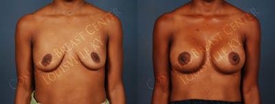 Enlargement - Silicone Before & After Gallery - Patient 592570 - Image 1