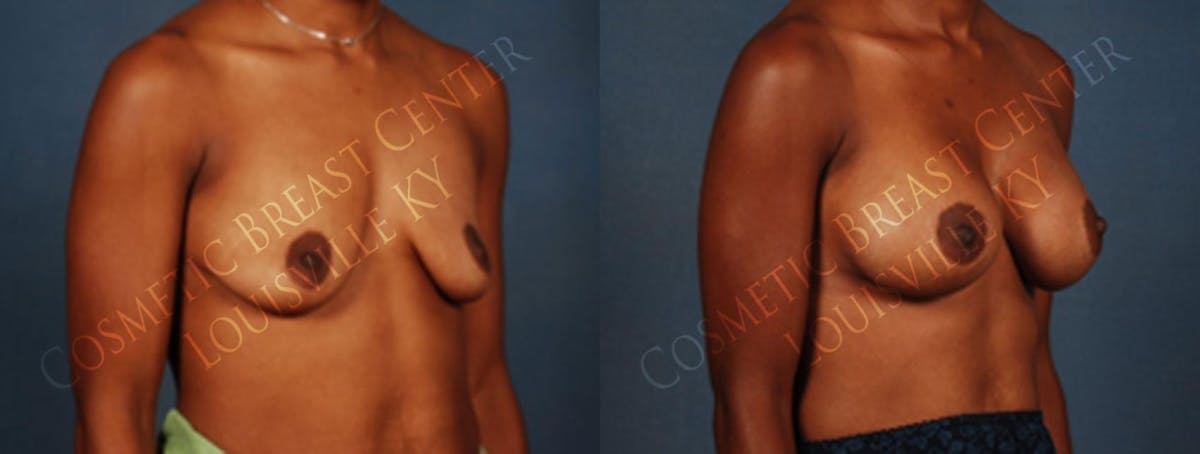 Enlargement - Silicone Before & After Gallery - Patient 592570 - Image 2
