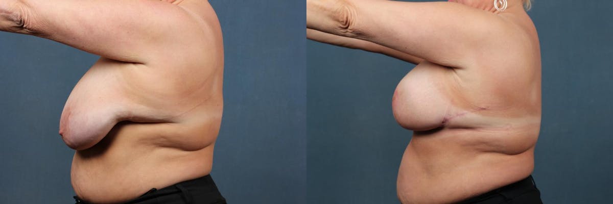 Lift Before & After Gallery - Patient 247270 - Image 3