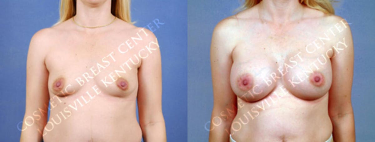 Enlargement - Silicone Before & After Gallery - Patient 680740 - Image 1