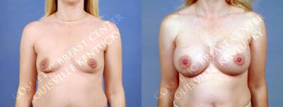 Enlargement - Silicone Before & After Gallery - Patient 680740 - Image 1