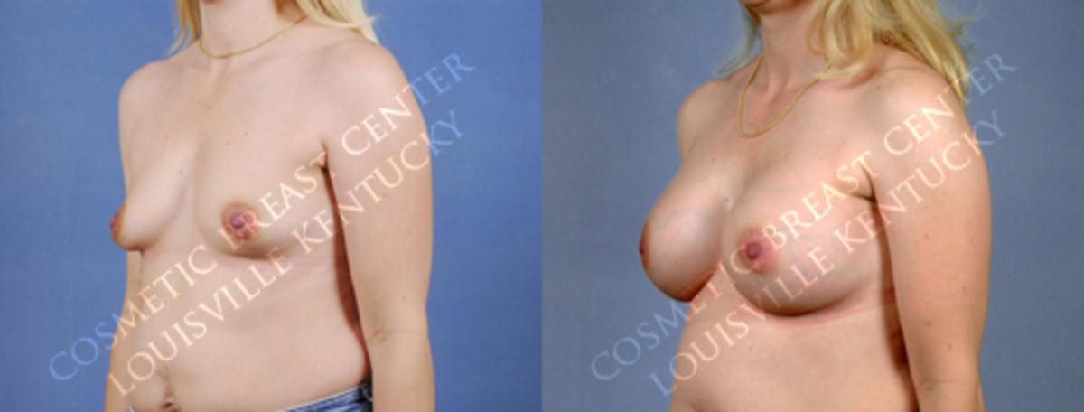 Enlargement - Silicone Before & After Gallery - Patient 680740 - Image 2