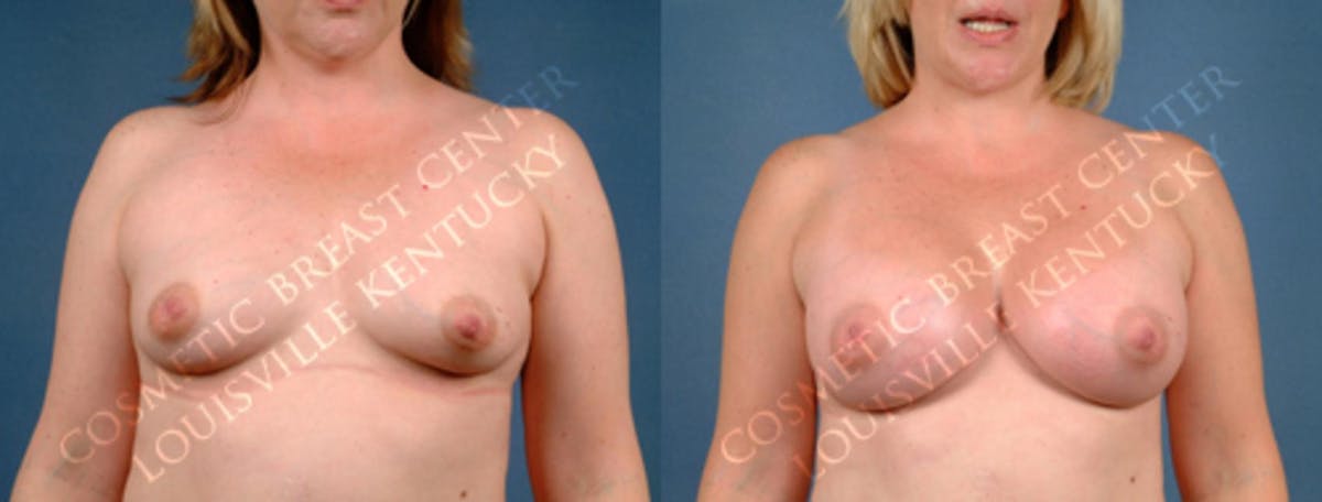 Enlargement - Silicone Before & After Gallery - Patient 268044 - Image 1