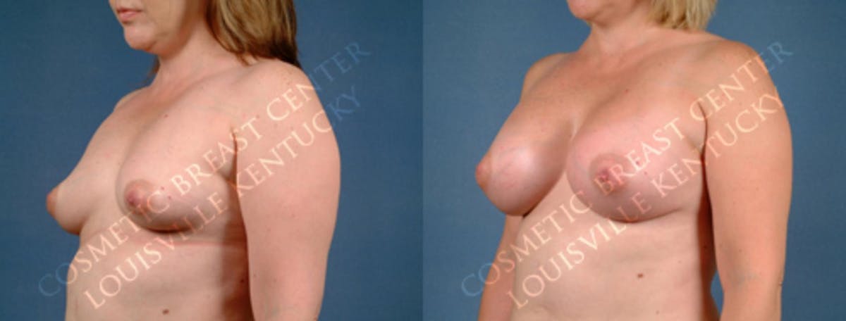 Enlargement - Silicone Before & After Gallery - Patient 268044 - Image 2
