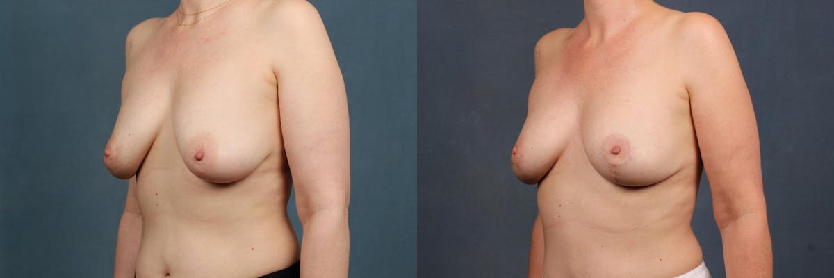 Lift Before & After Gallery - Patient 236732 - Image 2