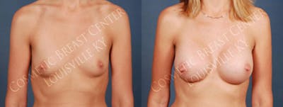 Enlargement - Silicone Before & After Gallery - Patient 258827 - Image 1