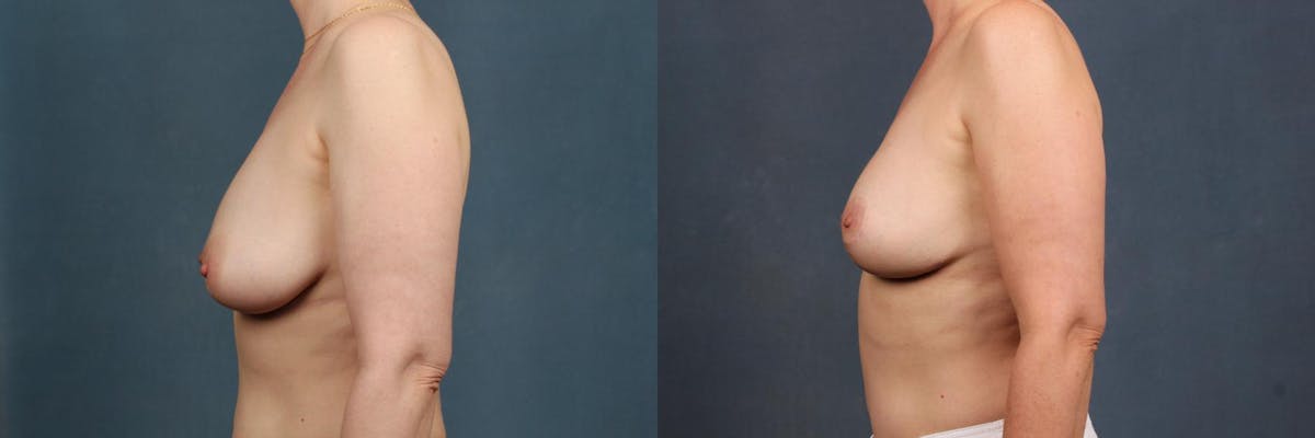 Lift Before & After Gallery - Patient 236732 - Image 3
