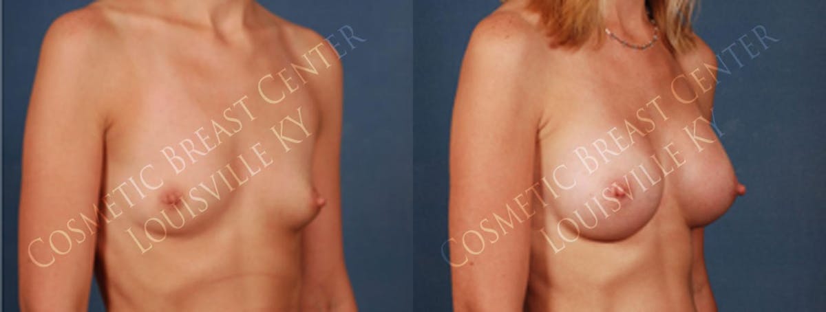 Enlargement - Silicone Before & After Gallery - Patient 258827 - Image 2