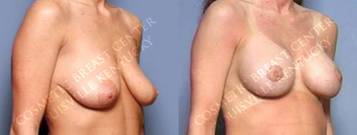 Lift Before & After Gallery - Patient 195646 - Image 2