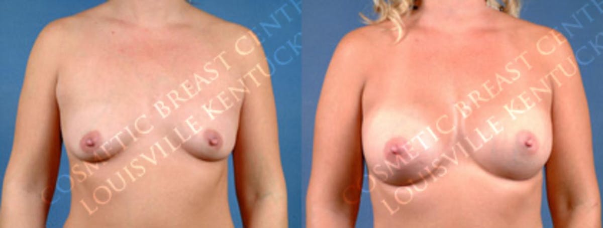 Enlargement - Silicone Before & After Gallery - Patient 302289 - Image 1