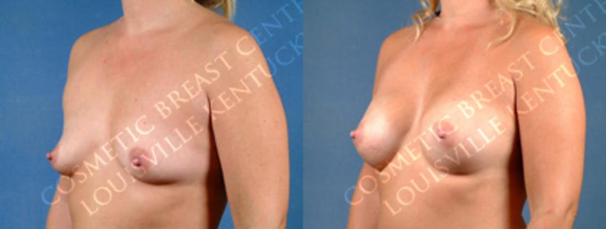 Enlargement - Silicone Before & After Gallery - Patient 302289 - Image 2