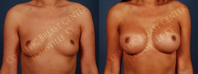 Enlargement - Silicone Before & After Gallery - Patient 232792 - Image 1