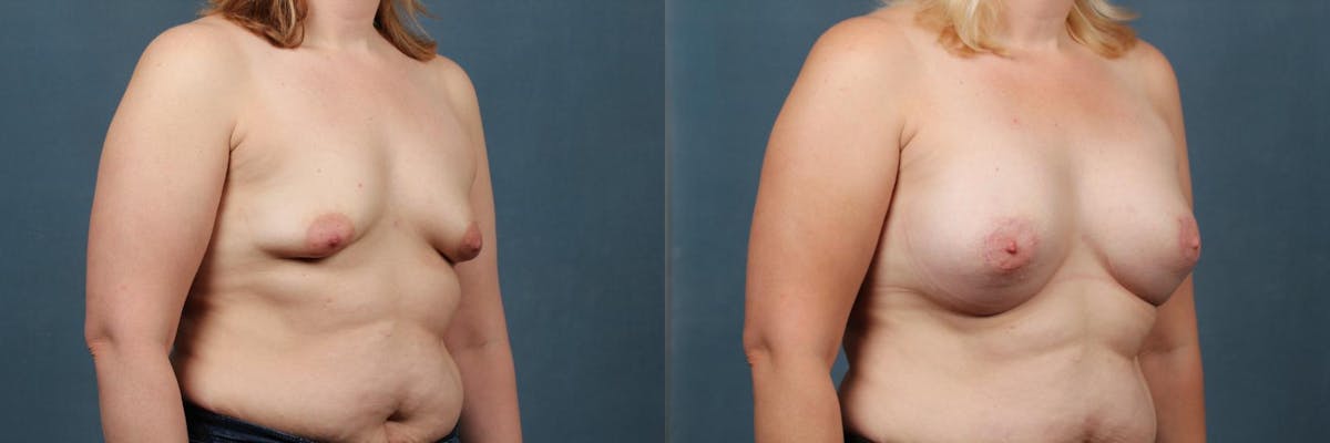 Lift Before & After Gallery - Patient 420686 - Image 3