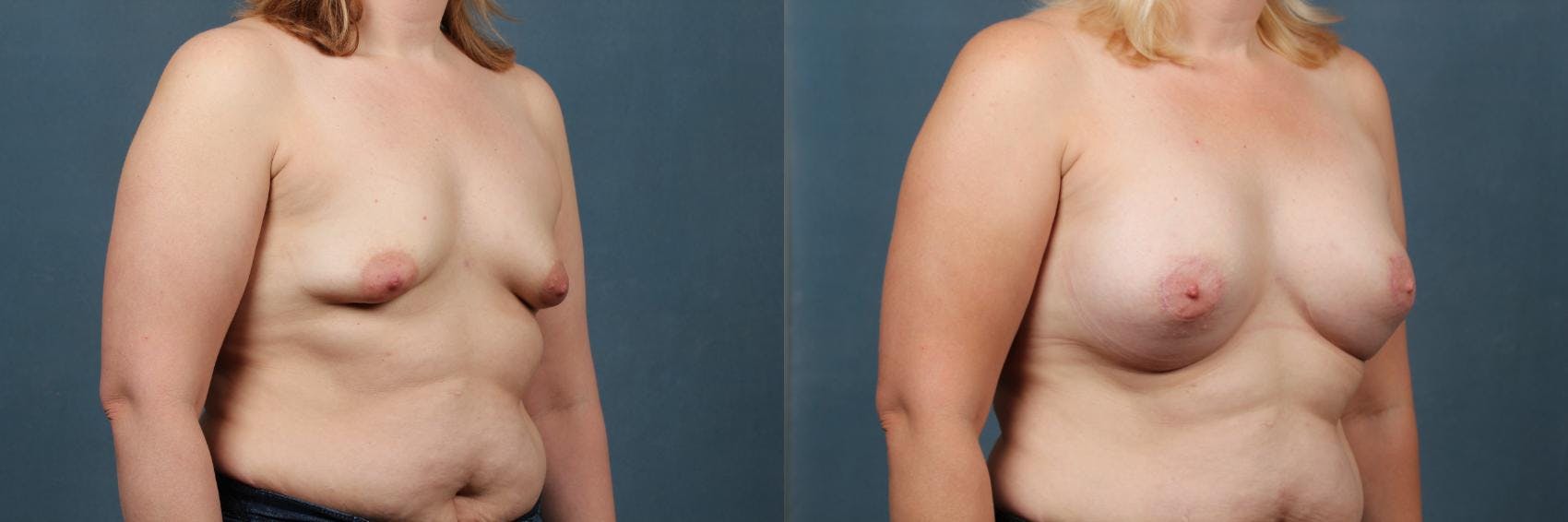 Lift Before & After Gallery - Patient 420686 - Image 3