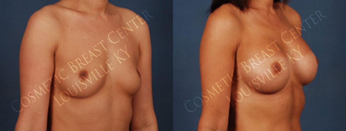 Enlargement - Silicone Before & After Gallery - Patient 232792 - Image 2