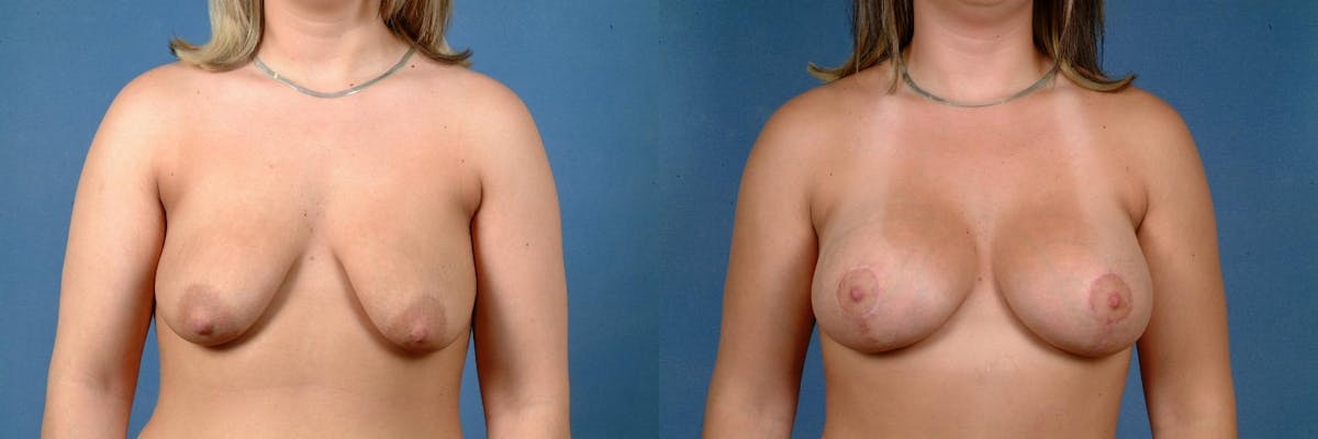 Lift Before & After Gallery - Patient 373509 - Image 1