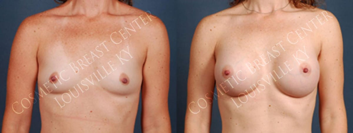 Enlargement - Silicone Before & After Gallery - Patient 201360 - Image 1