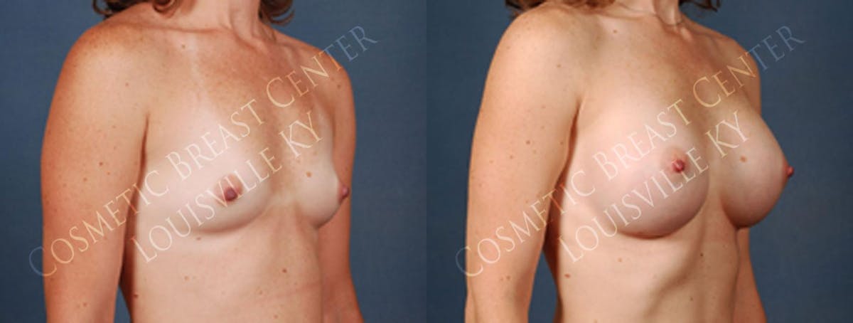 Enlargement - Silicone Before & After Gallery - Patient 201360 - Image 2