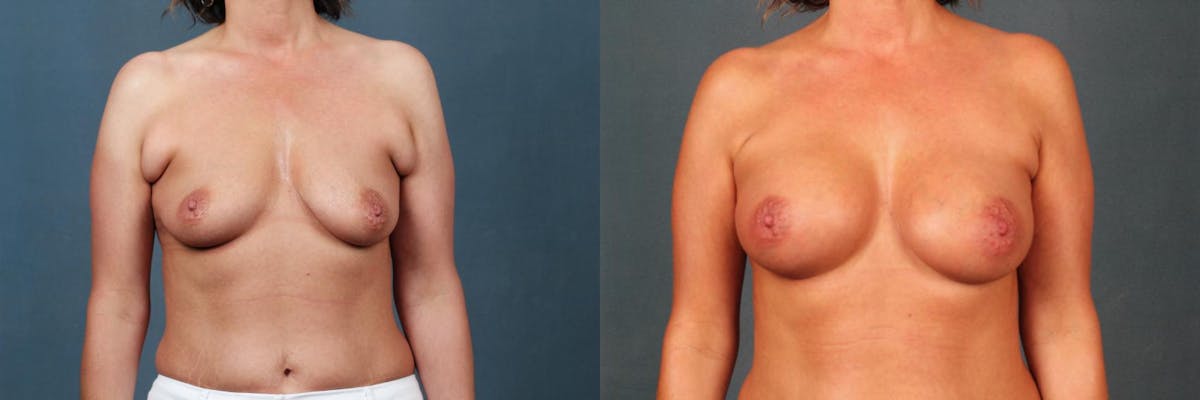 Lift Before & After Gallery - Patient 169855 - Image 1