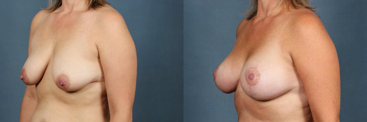 Lift Before & After Gallery - Patient 174718 - Image 2