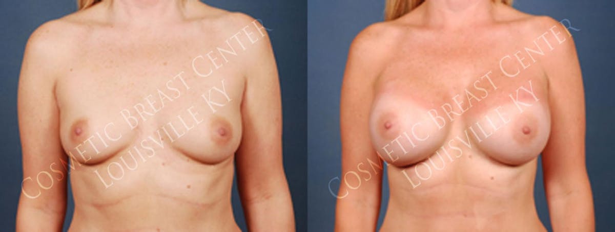 Enlargement - Silicone Before & After Gallery - Patient 309429 - Image 1