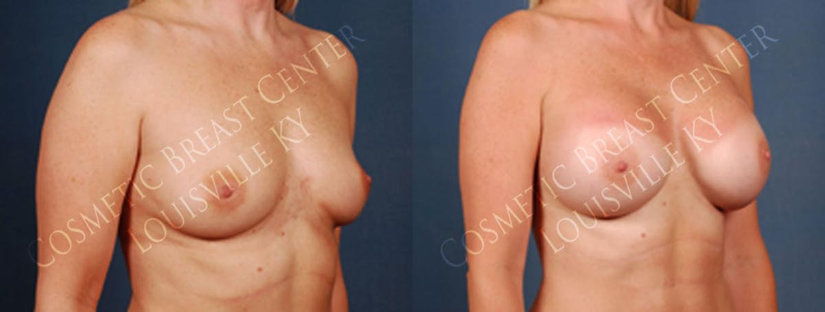 Enlargement - Silicone Before & After Gallery - Patient 309429 - Image 2