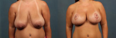 Lift Before & After Gallery - Patient 379363 - Image 1